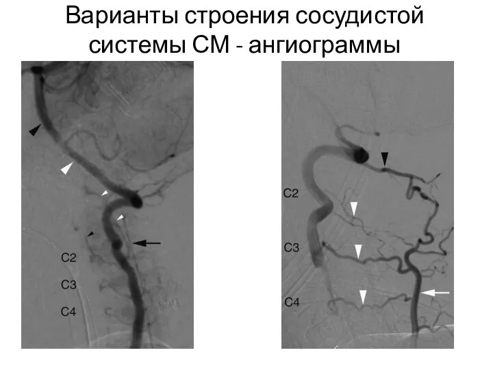 Варианты строения сосудистой системы СМ - ангиограммы