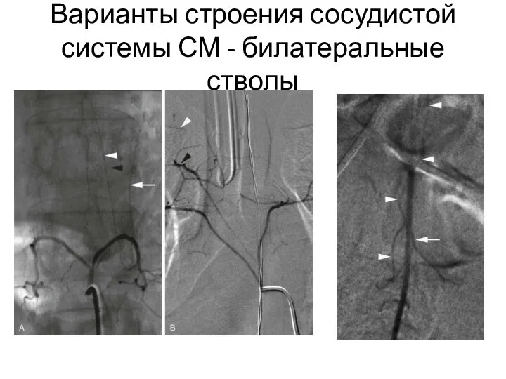 Варианты строения сосудистой системы СМ - билатеральные стволы