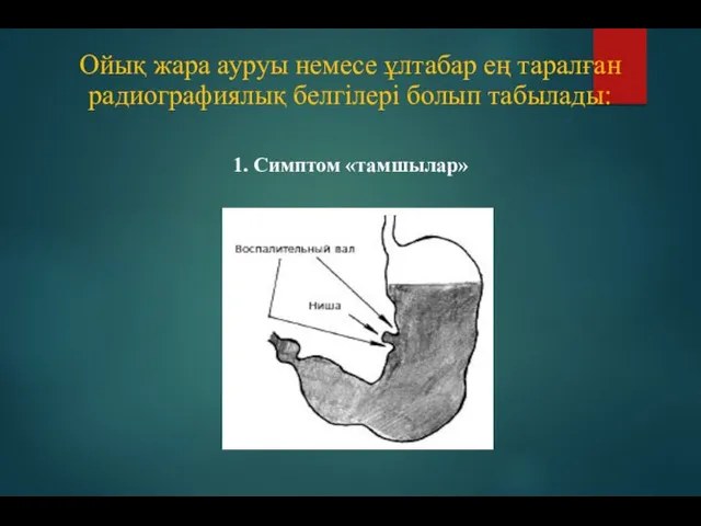 1. Симптом «тамшылар» Ойық жара ауруы немесе ұлтабар ең таралған радиографиялық белгілері болып табылады: