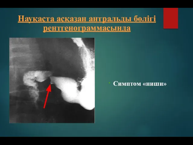 Симптом «ниши» Науқаста асқазан антральды бөлігі рентгенограммасында