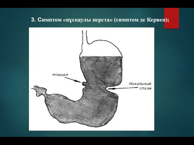 3. Симптом «нұскаулы перста» (симптом де Кервен);