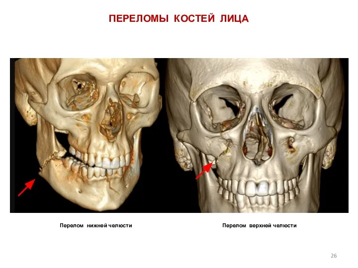 Перелом нижней челюсти Перелом верхней челюсти ПЕРЕЛОМЫ КОСТЕЙ ЛИЦА