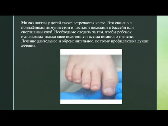 Микоз ногтей у детей также встречается часто. Это связано с пониженным иммунитетом