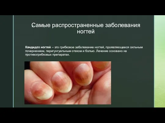 Самые распространенные заболевания ногтей Кандидоз ногтей – это грибковое заболевание ногтей, проявляющееся