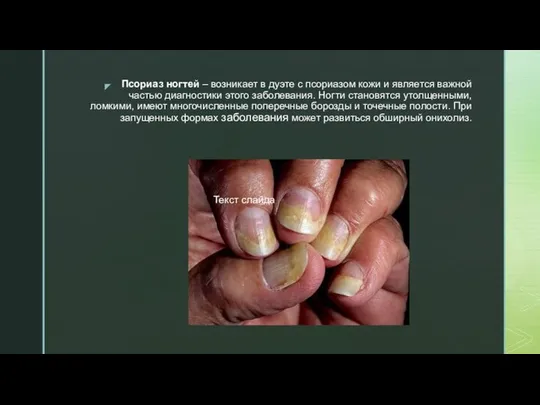 Псориаз ногтей – возникает в дуэте с псориазом кожи и является важной