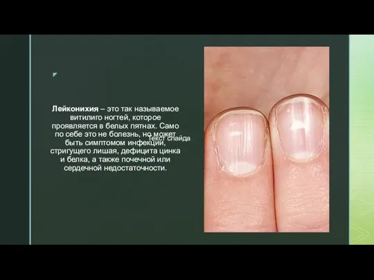 Лейконихия – это так называемое витилиго ногтей, которое проявляется в белых пятнах.
