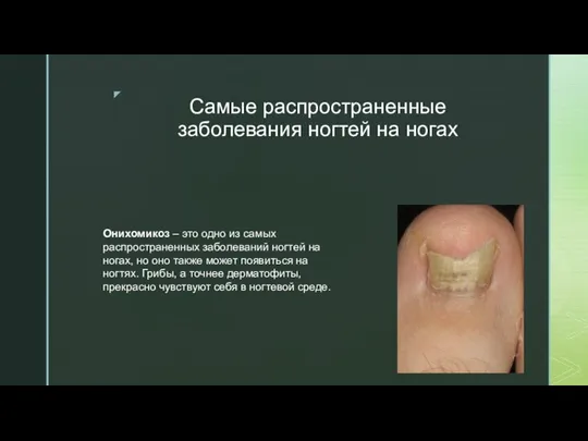 Самые распространенные заболевания ногтей на ногах Онихомикоз – это одно из самых