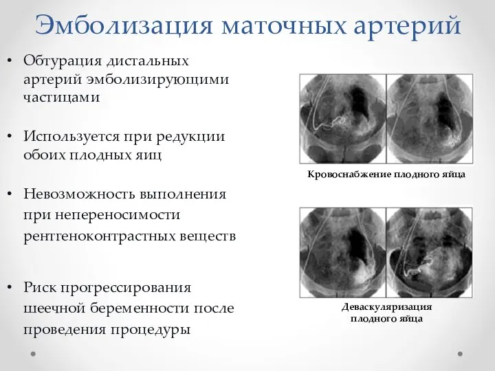 Эмболизация маточных артерий Обтурация дистальных артерий эмболизирующими частицами Используется при редукции обоих