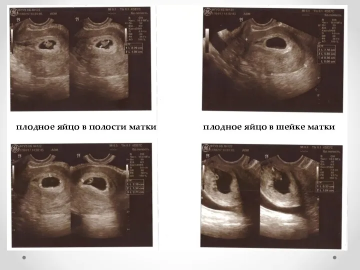 плодное яйцо в полости матки плодное яйцо в шейке матки