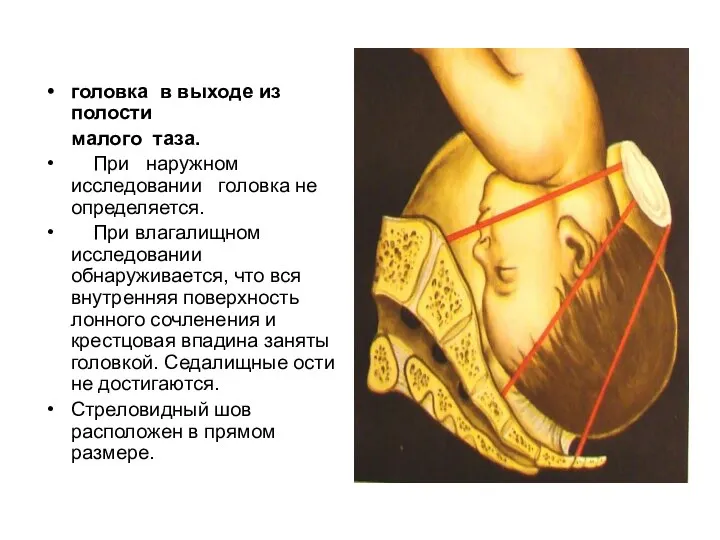 головка в выходе из полости малого таза. При наружном исследовании головка не