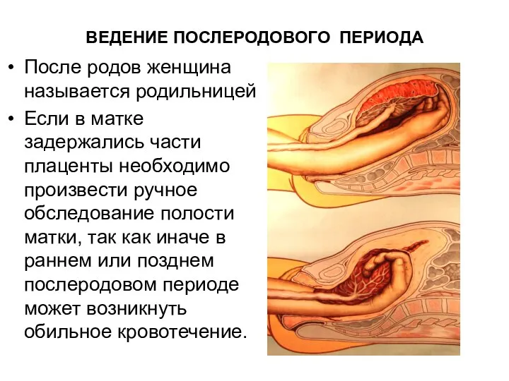 После родов женщина называется родильницей Если в матке задержались части плаценты необходимо