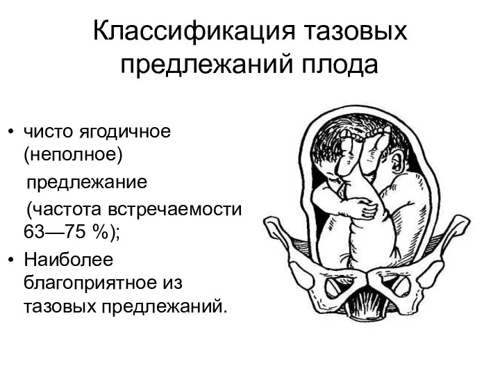 Классификация тазовых предлежаний плода чисто ягодичное (неполное) предлежание (частота встречаемости 63—75 %);