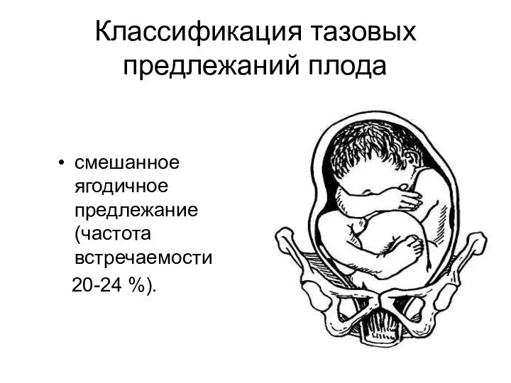 Классификация тазовых предлежаний плода смешанное ягодичное предлежание (частота встречаемости 20-24 %).