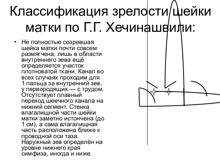 Не полностью созревшая шейка матки почти совсем размягчена, лишь в области внутреннего