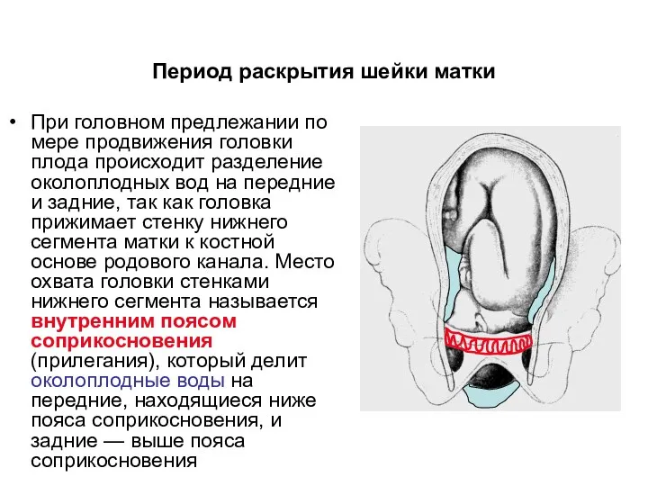 При головном предлежании по мере продвижения головки плода происходит разделение околоплодных вод