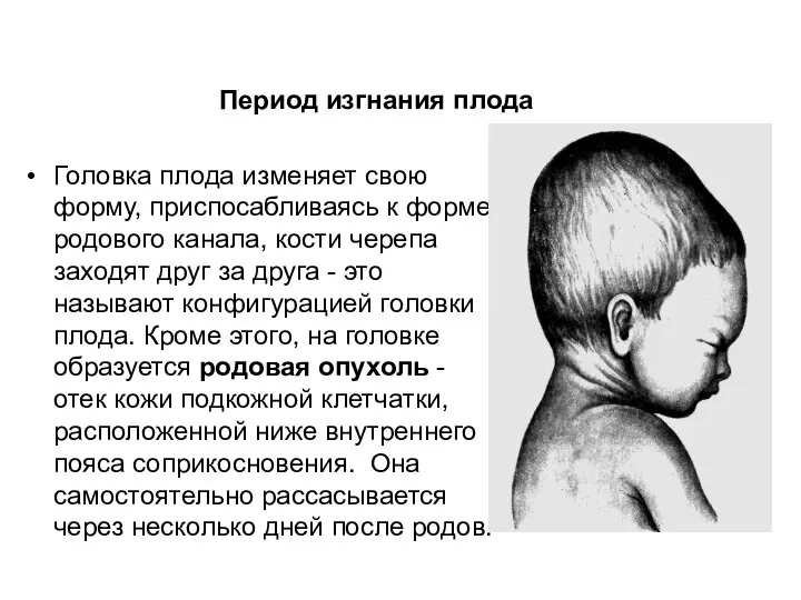 Головка плода изменяет свою форму, приспосабливаясь к форме родового канала, кости черепа