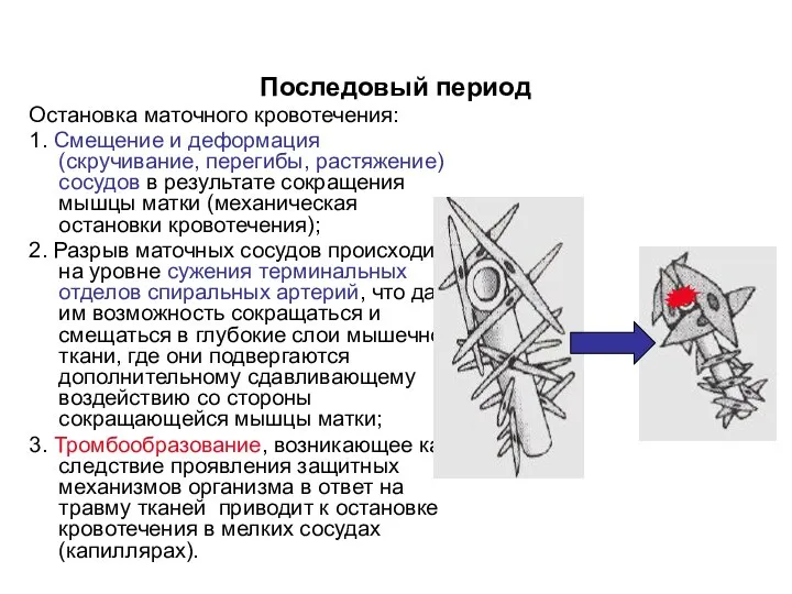 Остановка маточного кровотечения: 1. Смещение и деформация (скручивание, перегибы, растяжение) сосудов в