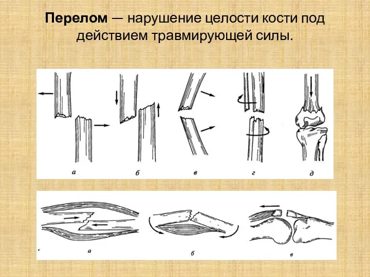 Перелом — нарушение целости кости под действием травмирующей силы.