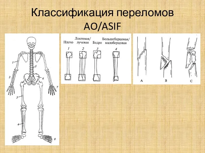 Классификация переломов AO/ASIF