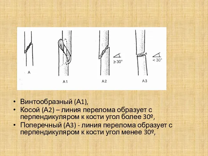 Винтообразный (А1), Косой (А2) – линия перелома образует с перпендикуляром к кости