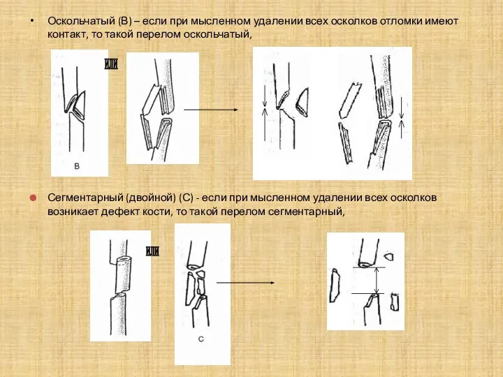 Оскольчатый (В) – если при мысленном удалении всех осколков отломки имеют контакт,