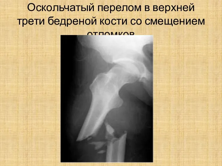 Оскольчатый перелом в верхней трети бедреной кости со смещением отломков