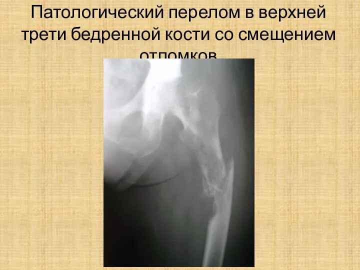 Патологический перелом в верхней трети бедренной кости со смещением отломков