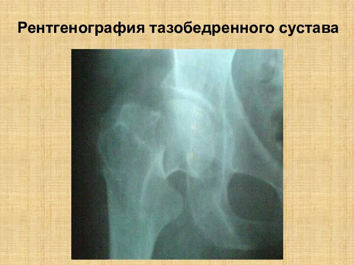 Рентгенография тазобедренного сустава