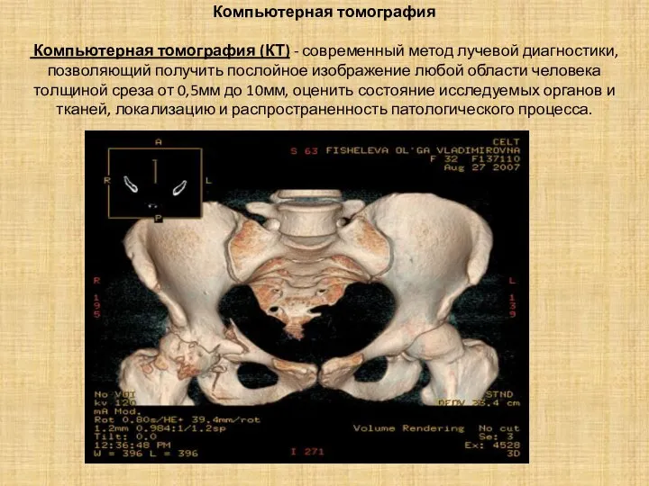 Компьютерная томография Компьютерная томография (КТ) - современный метод лучевой диагностики, позволяющий получить