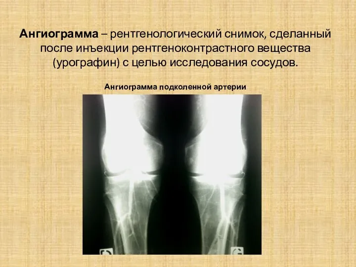 Ангиограмма – рентгенологический снимок, сделанный после инъекции рентгеноконтрастного вещества (урографин) с целью