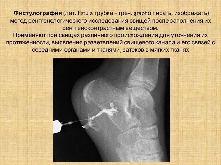 Фистулографи́я (лат. fistula трубка + греч. graphō писать, изображать) метод рентгенологического исследования