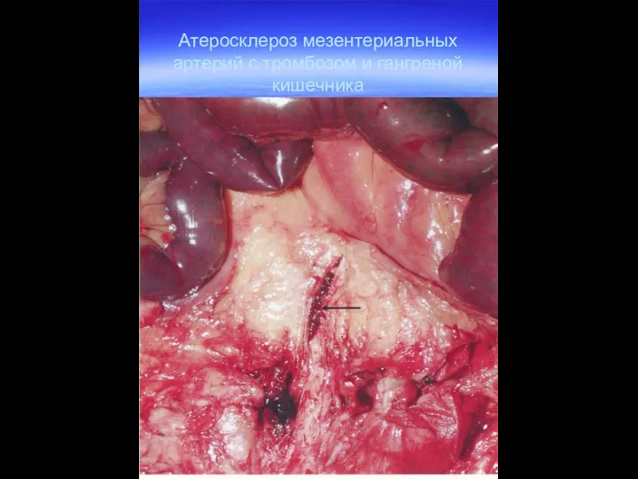 Атеросклероз мезентериальных артерий с тромбозом и гангреной кишечника