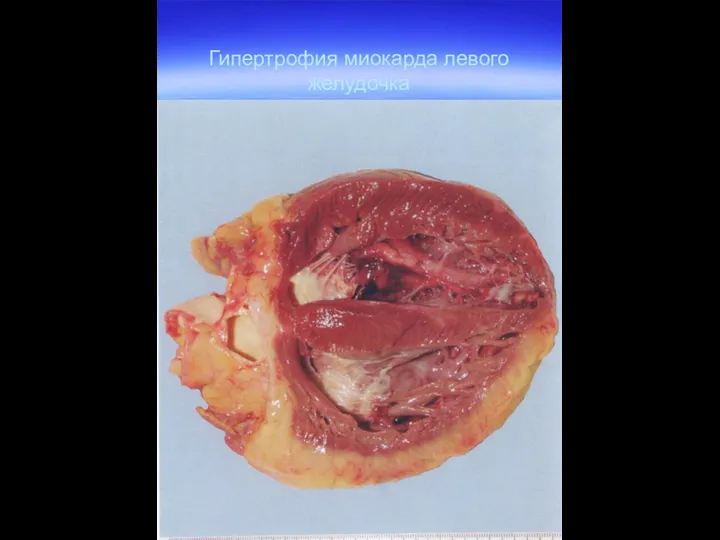 Гипертрофия миокарда левого желудочка