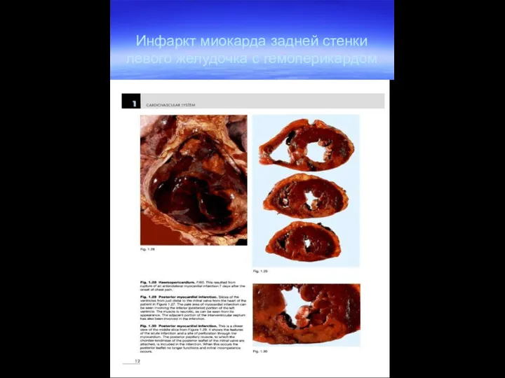 Инфаркт миокарда задней стенки левого желудочка с гемоперикардом
