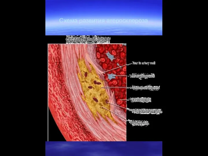 Схема развития атеросклероза