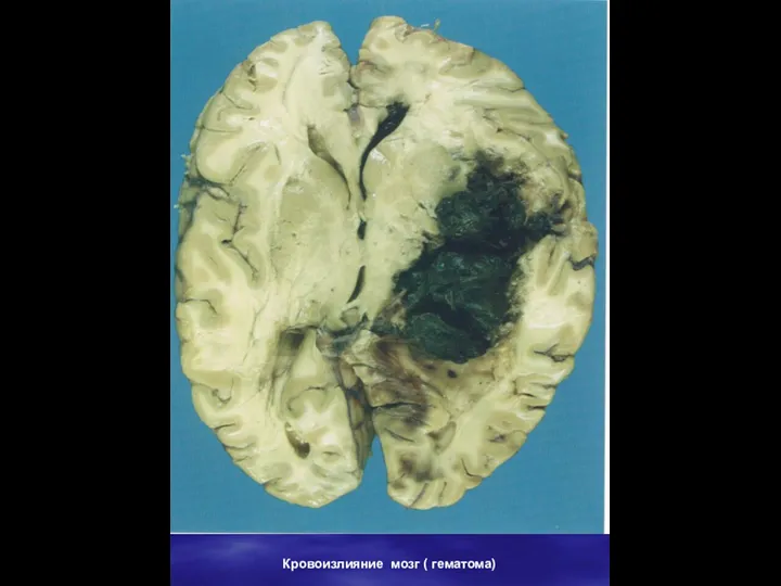 Кровоизлияние мозг ( гематома)