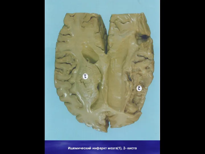 Ишемический инфаркт мозга(1), 2- киста