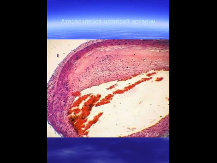 Атеросклероз мозговой артерии