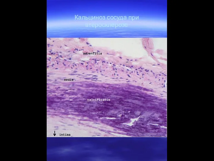 Кальциноз сосуда при атеросклерозе