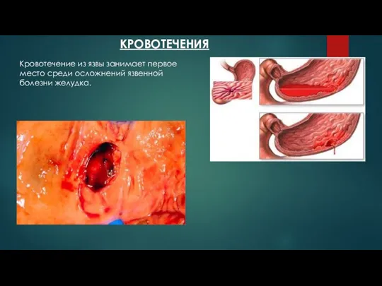 КРОВОТЕЧЕНИЯ Кровотечение из язвы занимает первое место среди осложнений язвенной болезни желудка.