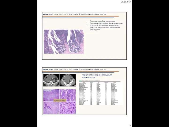 26.10.2019 WHO 2019: ОПУХОЛИ ТОЛСТОЙ И ПРЯМОЙ КИШКИ/ НОВЫЕ НОЗОЛОГИИ Аденома-подобная карцинома