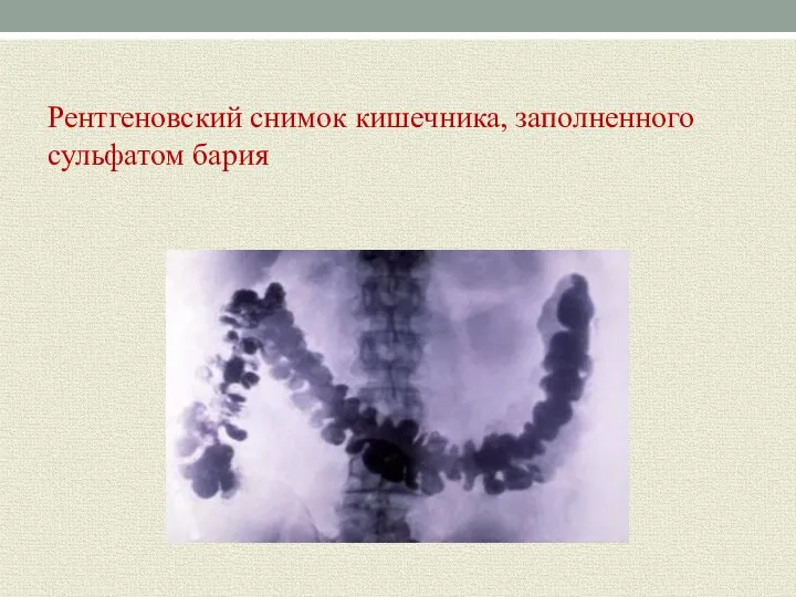 Рентгеновский снимок кишечника, заполненного сульфатом бария