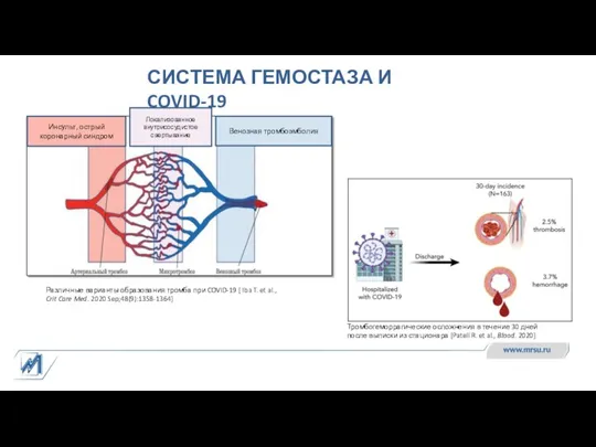 СИСТЕМА ГЕМОСТАЗА И COVID-19 Различные варианты образования тромба при COVID-19 [ Iba