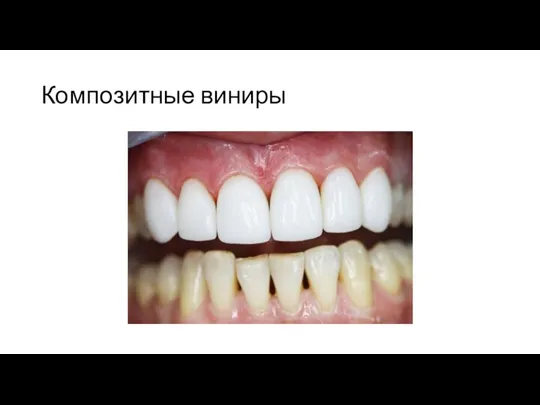 Композитные виниры