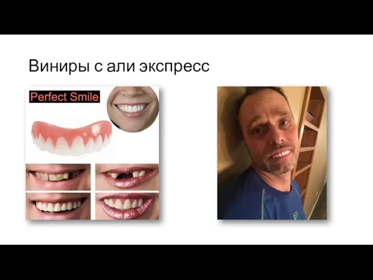 Виниры с али экспресс