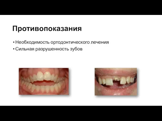 Противопоказания Необходимость ортодонтического лечения Сильная разрушенность зубов