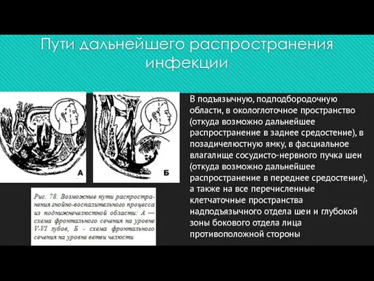 Пути дальнейшего распространения инфекции В подъязычную, подподбородочную области, в окологлоточное пространство (откуда