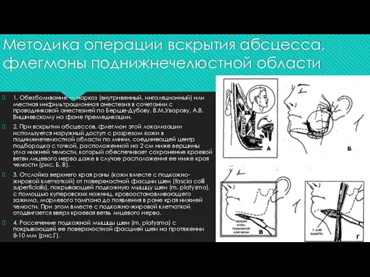 Методика операции вскрытия абсцесса, флегмоны поднижнечелюстной области 1. Обезболивание — наркоз (внутривенный,