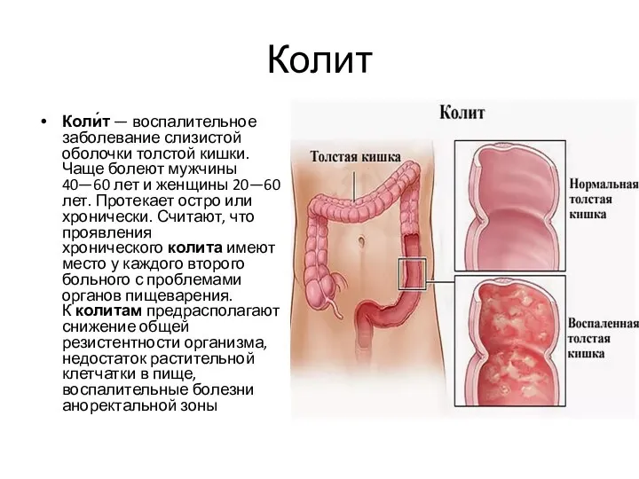 Колит Коли́т — воспалительное заболевание слизистой оболочки толстой кишки. Чаще болеют мужчины