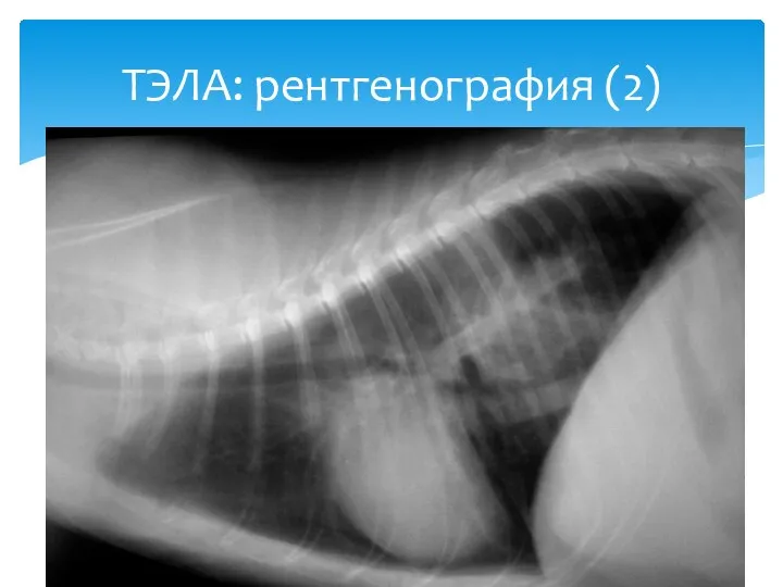 ТЭЛА: рентгенография (2)
